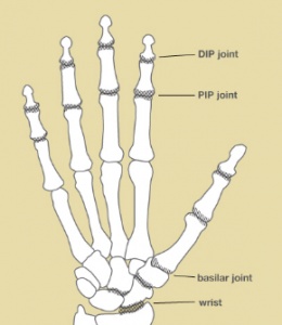 Osteoarthritis Of The Hands – Carolyn Yang, Md