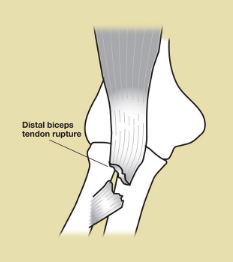 Distal Biceps Tendon Problems – Carolyn Yang, MD